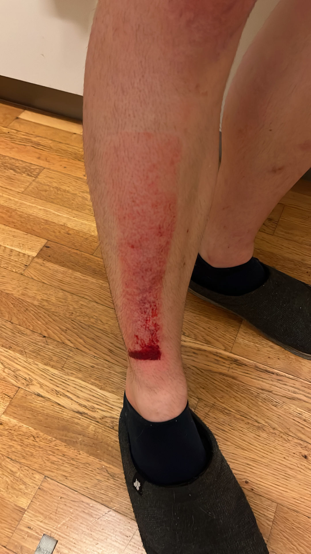 chinbone injury