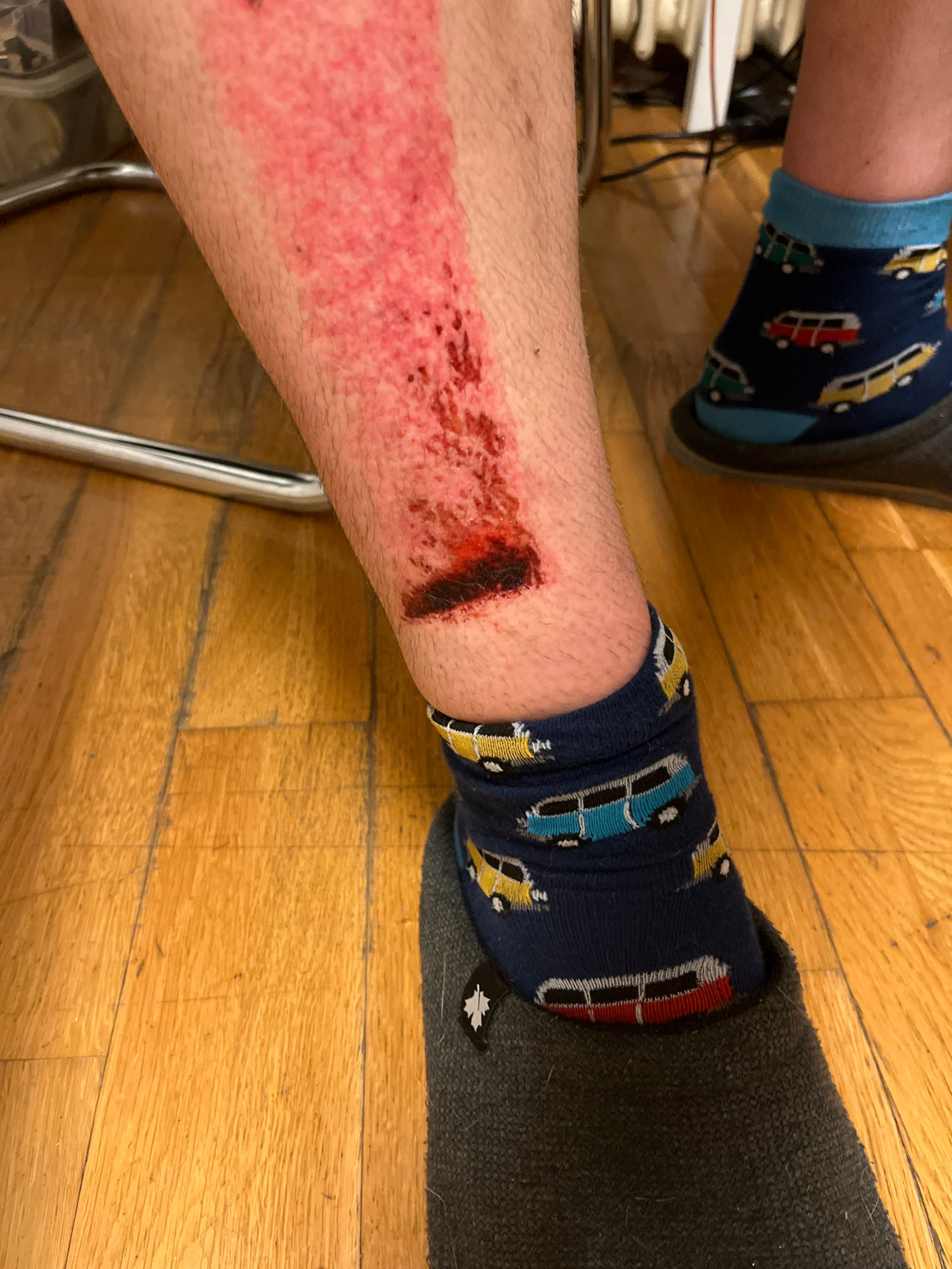chinbone accident 2