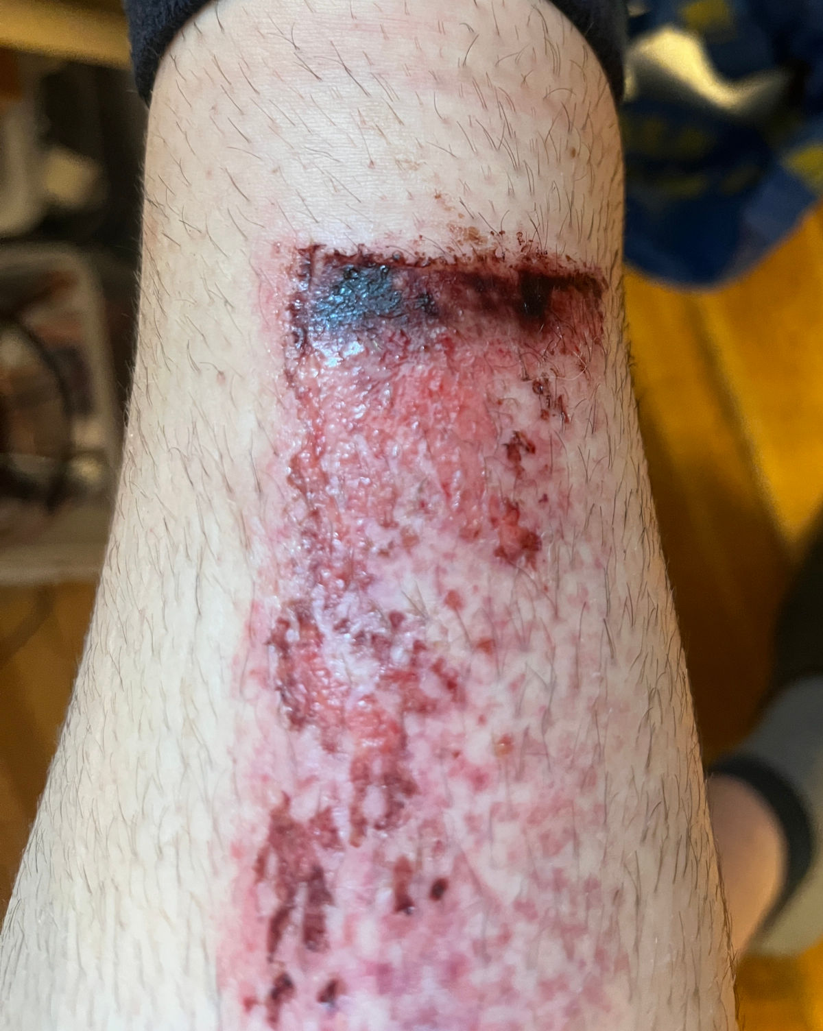 chinbone accident 2025-06-19