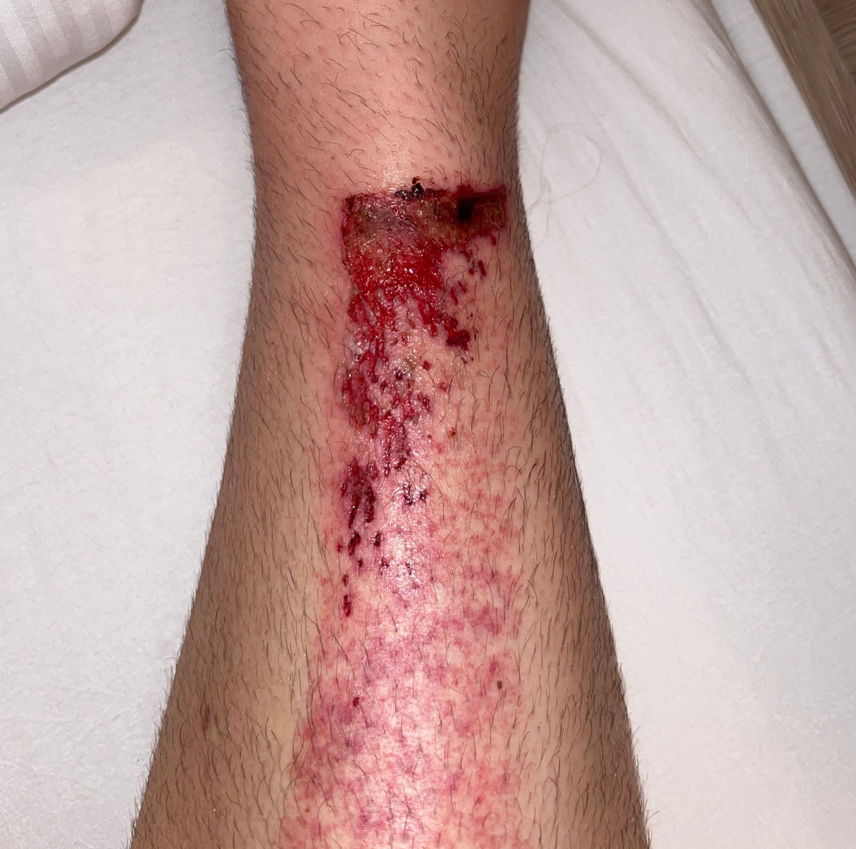 chinbone accident 2025-06-20