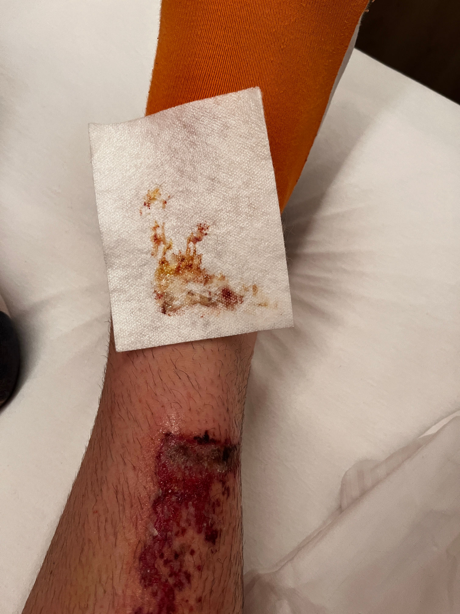 chinbone accident 2025-06-21