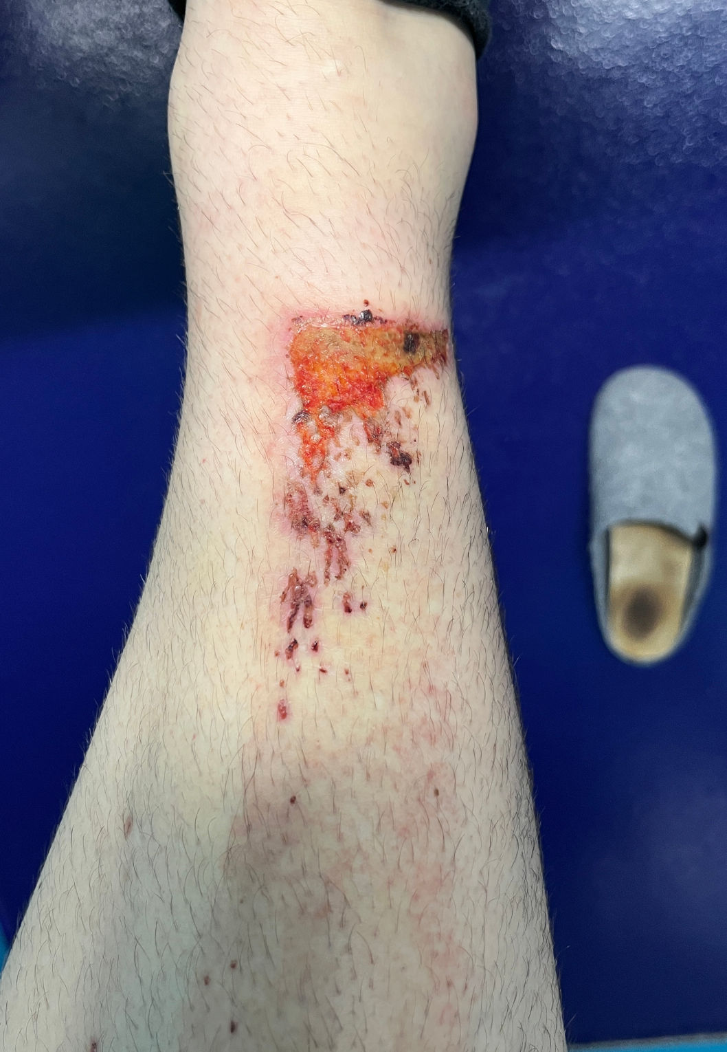 chinbone accident 2025-06-21